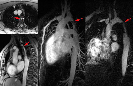 Angio IRM 3D avec gadolinium d'une coarctation aortique