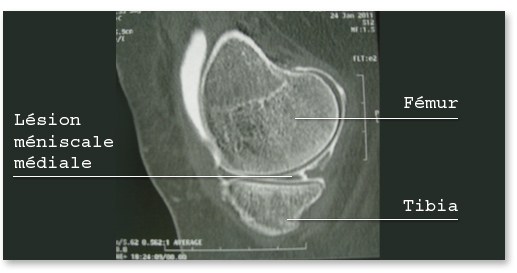 Meniscal and ligament injuries of the knee