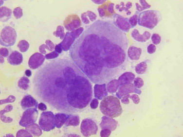 Thrombocytosis